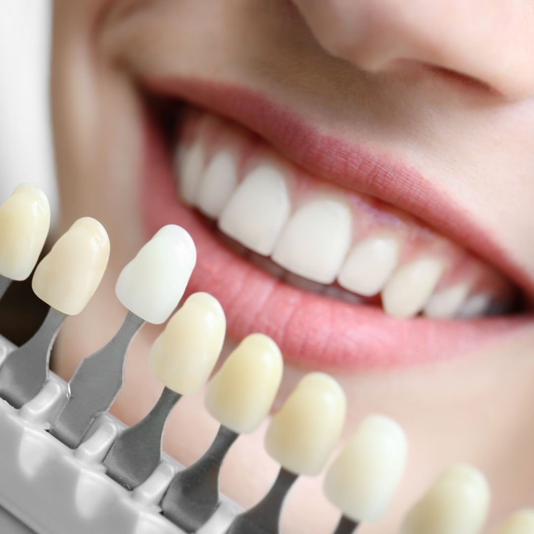 Tooth shade matching for smile design at Dentistree Kolkata.