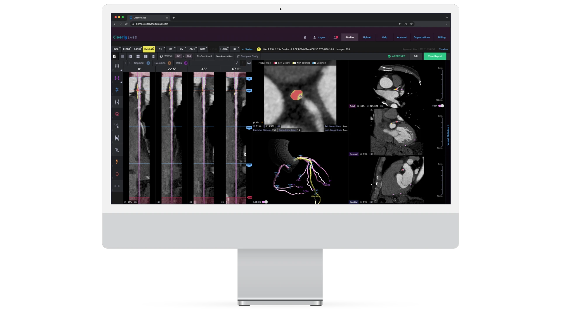 Cleerly results portal for advanced heart imaging and testing at Harper Health.