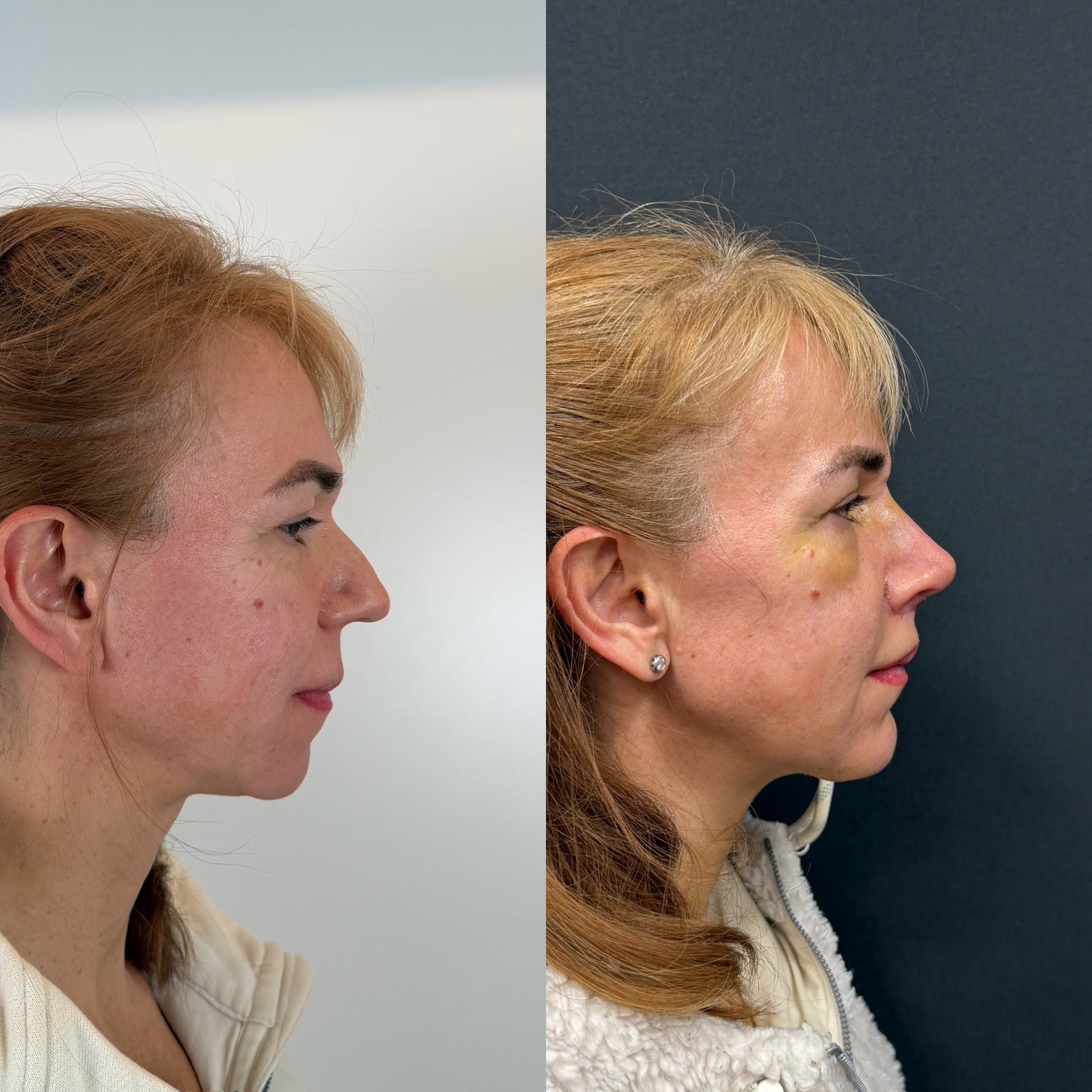 piezo rhinoplasty with chin implant right