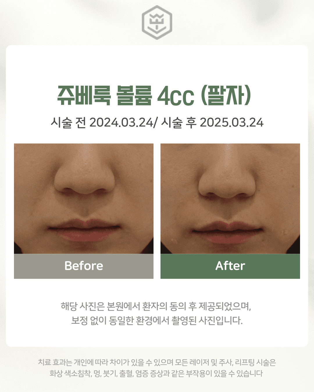 쥬베룩 볼륨 4cc (팔자)