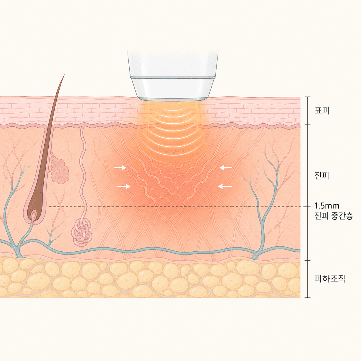 인모드 FX는 표피를 건드리지 않고 진피층에 열을 전달해 콜라겐을 자극해요.