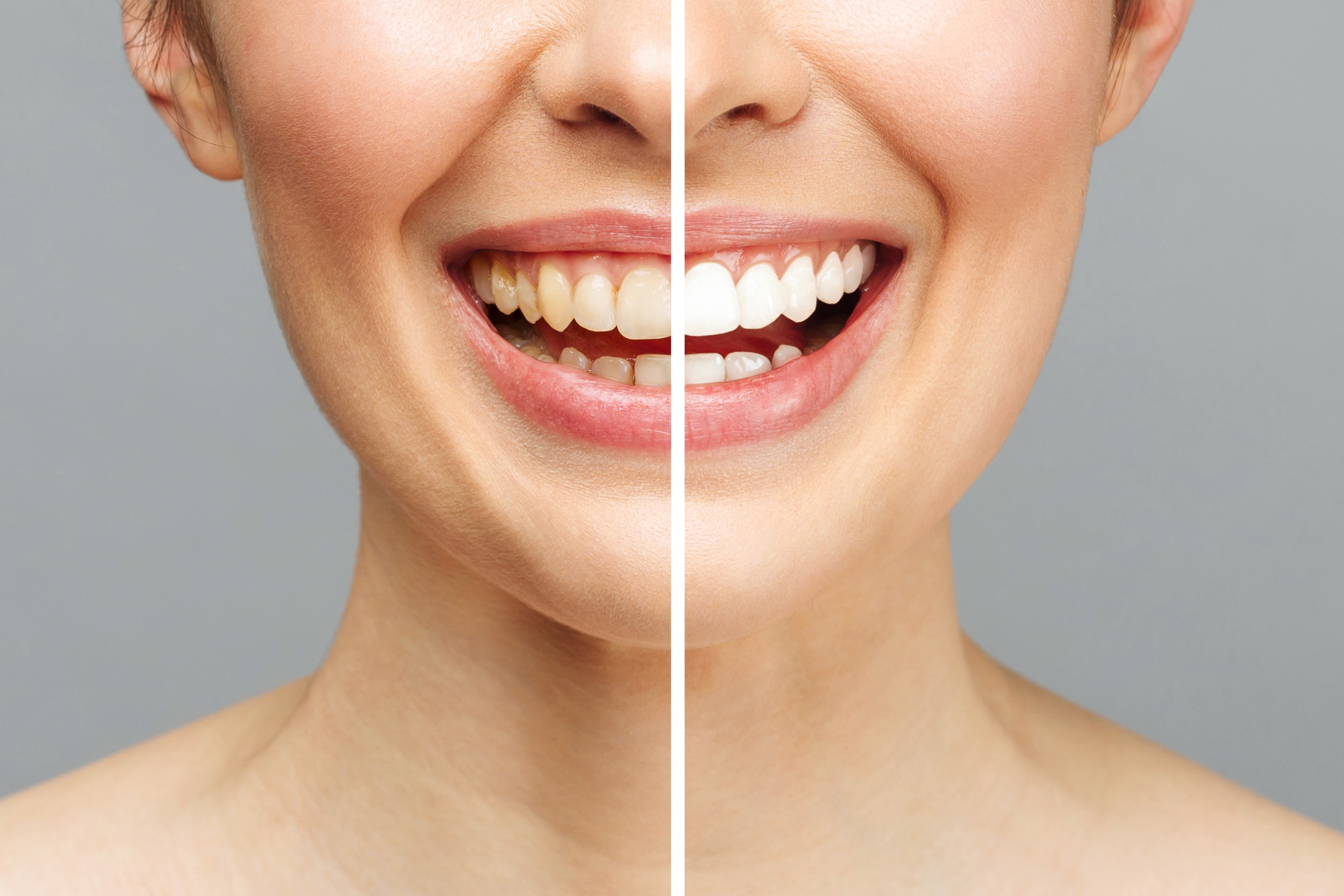 teeth whitening