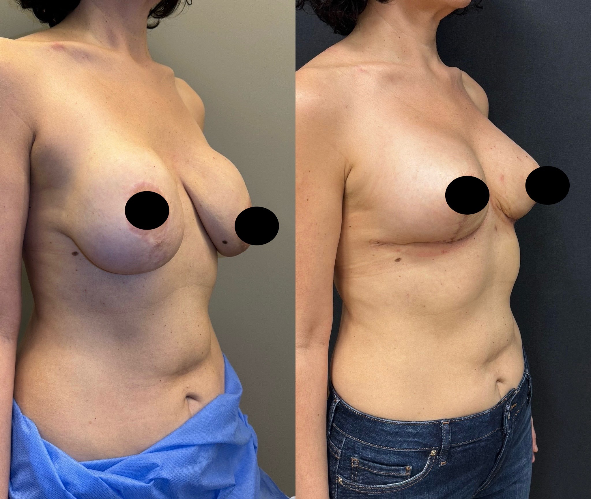 waterfall deformity correction before after breast lift with implant revision right oblique view