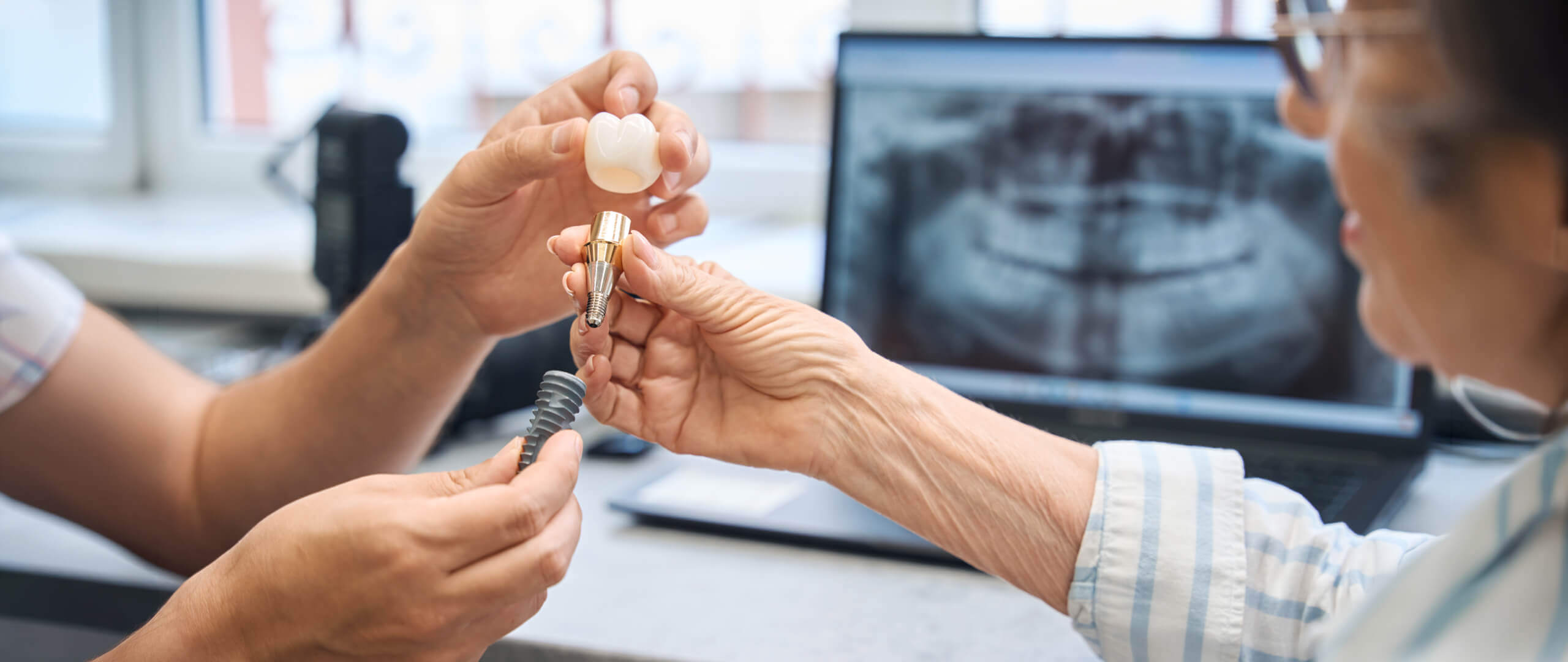 Implantes Dentários