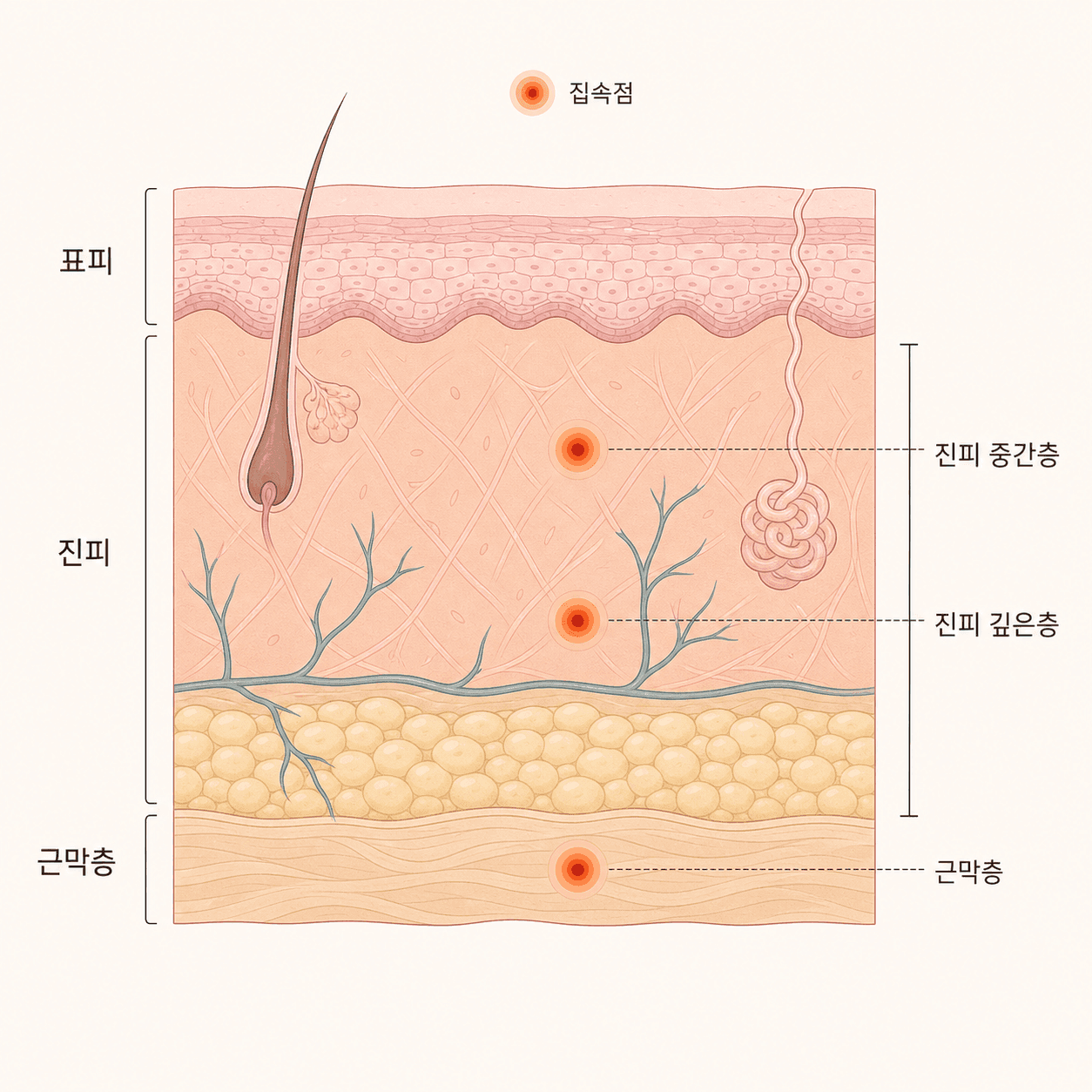 표피·진피·근막층과 깊이별 초음파 열 응고점