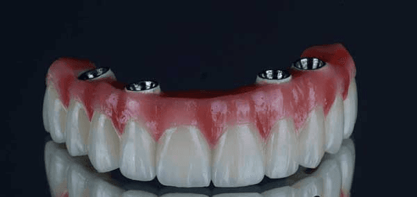 All-on-4 full-arch dental implant restoration