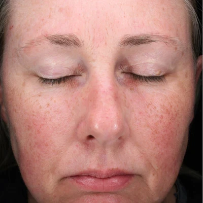 Before soothing anti-inflammatory treatment at The Vancouver Aesthetician — visible rosacea and facial redness on skin