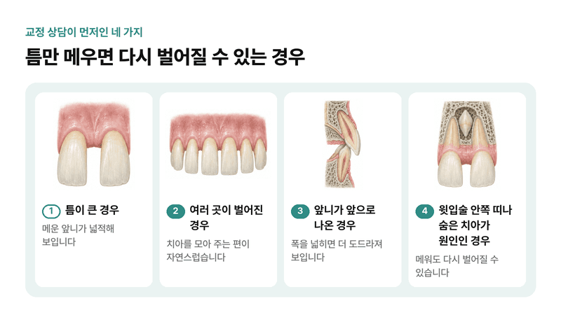 앞니 사이 틈이 큰 경우, 여러 곳이 벌어진 경우, 앞니가 앞으로 나온 경우, 윗입술 안쪽 띠나 숨은 치아가 원인인 경우처럼 교정 상담이 먼저인 네 가지를 그린 일러스트