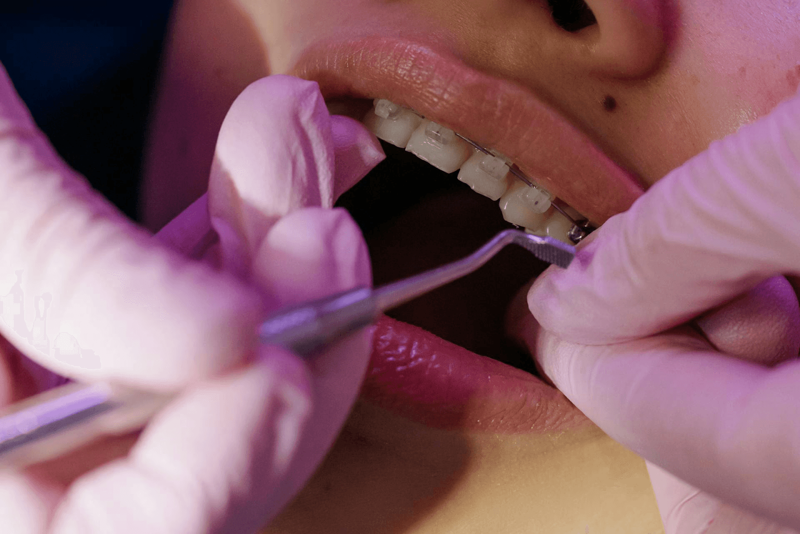 Ceramic braces are less noticeable while still providing effective teeth alignment.