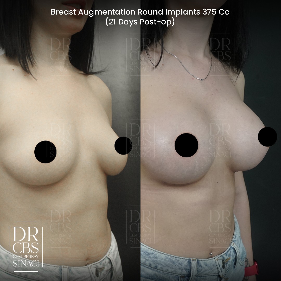 21 days result breast implant oblique view