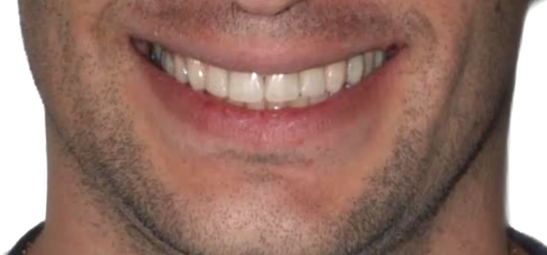 Harmonised occlusion and aesthetic restorations. No surgery