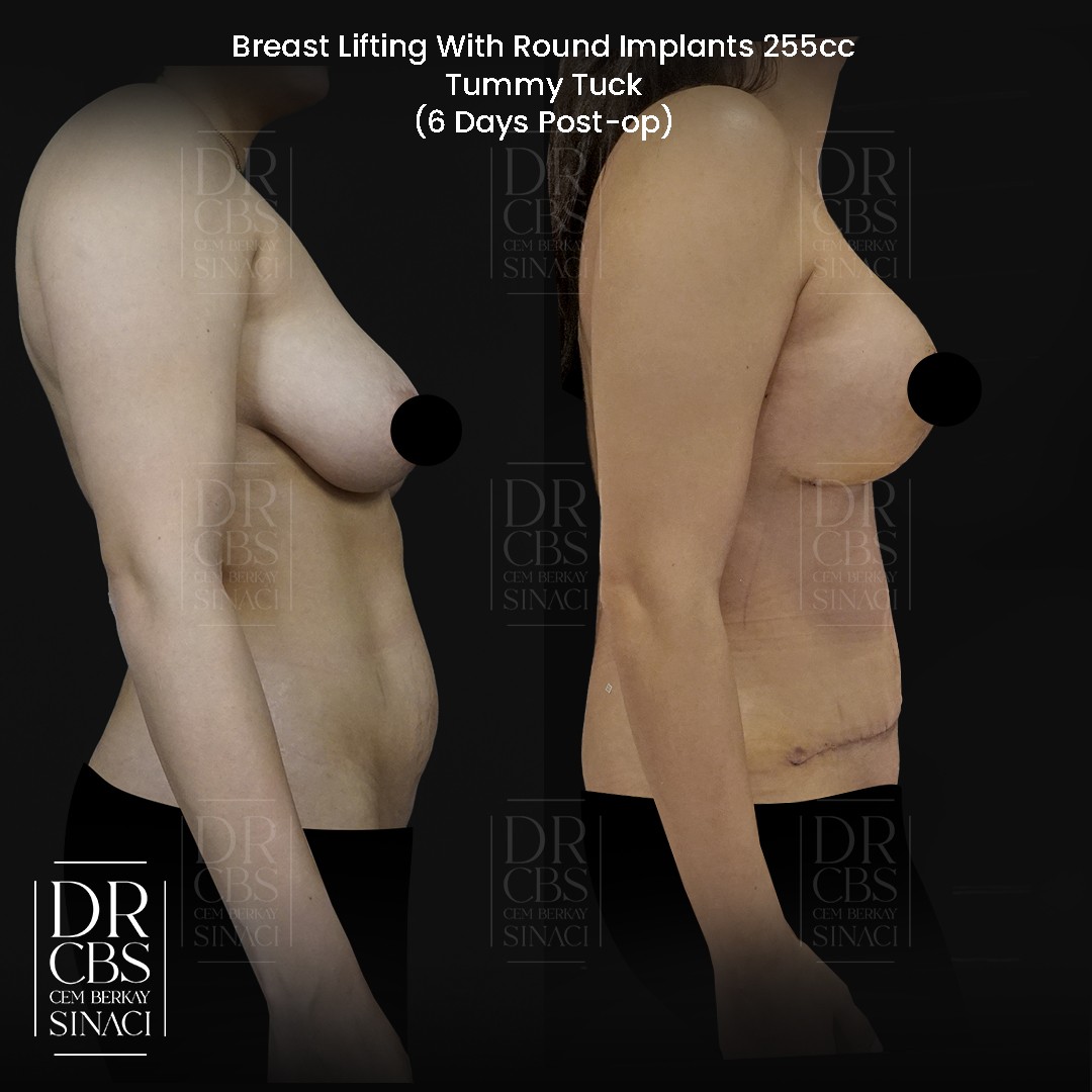 breast uplift with implant and abdominoplasty tummy tuck before after side view