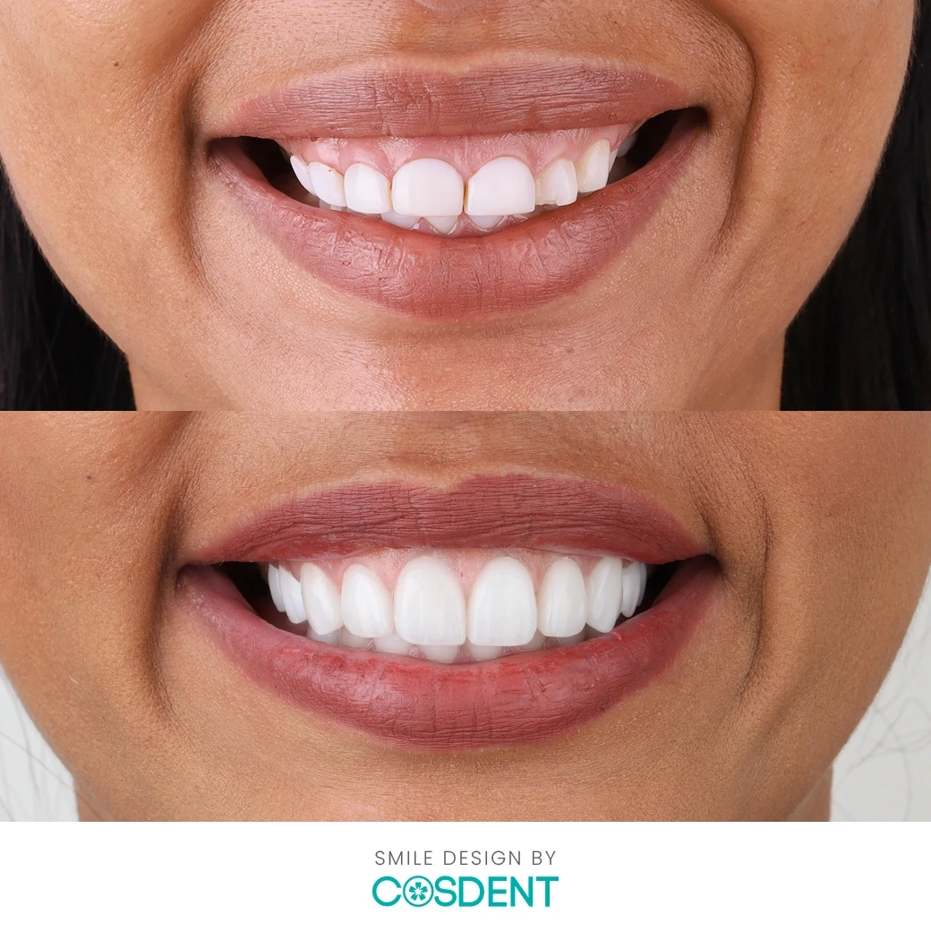 รีวิวออกแบบรอยยิ้ม ที่ cosdent smile design