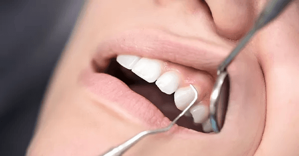 Gum disease causes