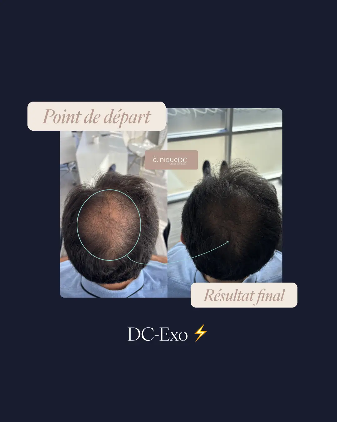 une photo du vortex du front d'un avant-après prp exosome perte de cheveux a laval dans une clinique medico-esthetique