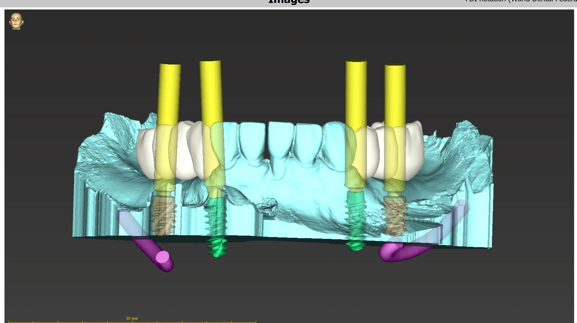 3D dental model displaying four dental implant placements in the upper jaw with three prosthetic teeth; features highlighted in yellow and purple for alignment visualization at Oakville Dental Implant Studio.