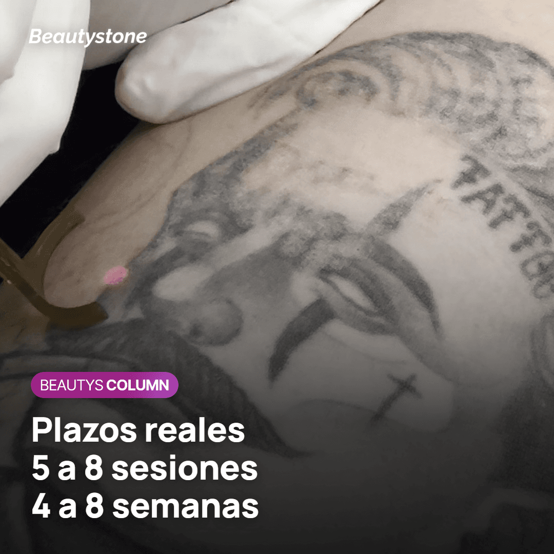 ¿Se puede eliminar del todo antes del verano? Coste y plazos reales