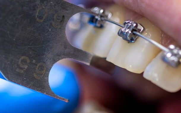 Лікар налаштовує брекети пацієнтці