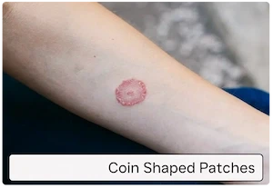 Coin-shaped circular patches