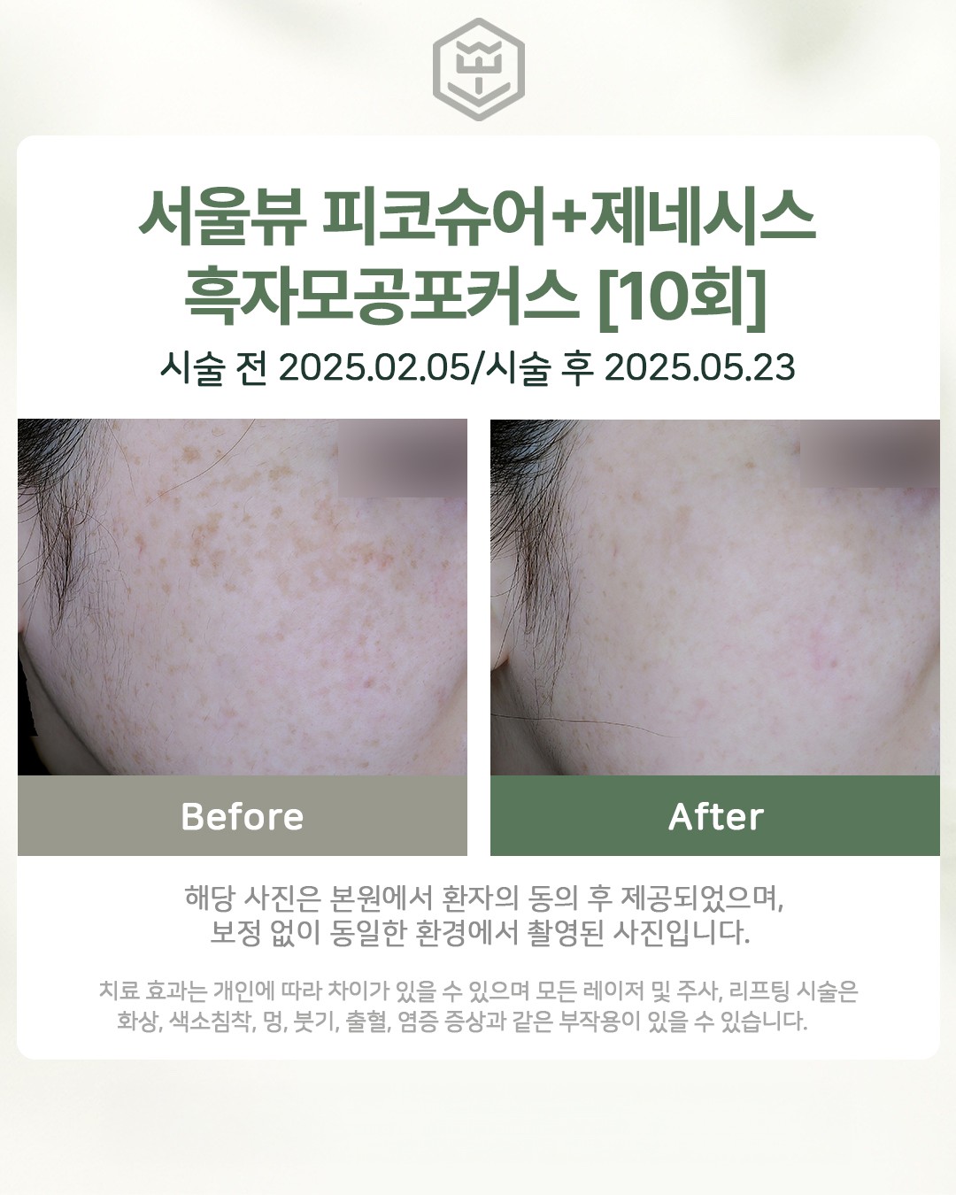 피코슈어+제네시스+흑자모공포커스 10회