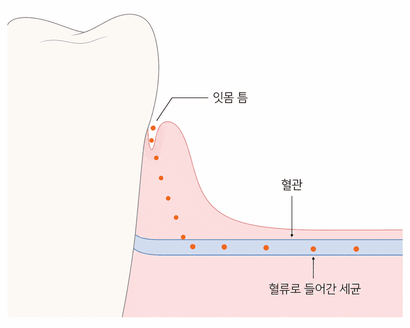 잇몸 틈에서 혈관까지의 거리는 생각보다 가까워요.