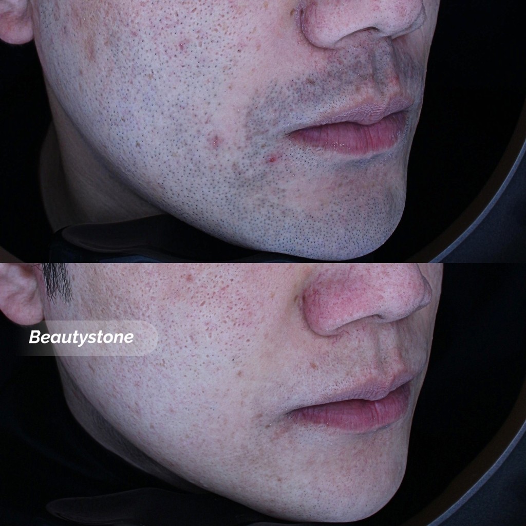 남자 얼굴 전체 제모, 어디서 어디까지 가능한가요?