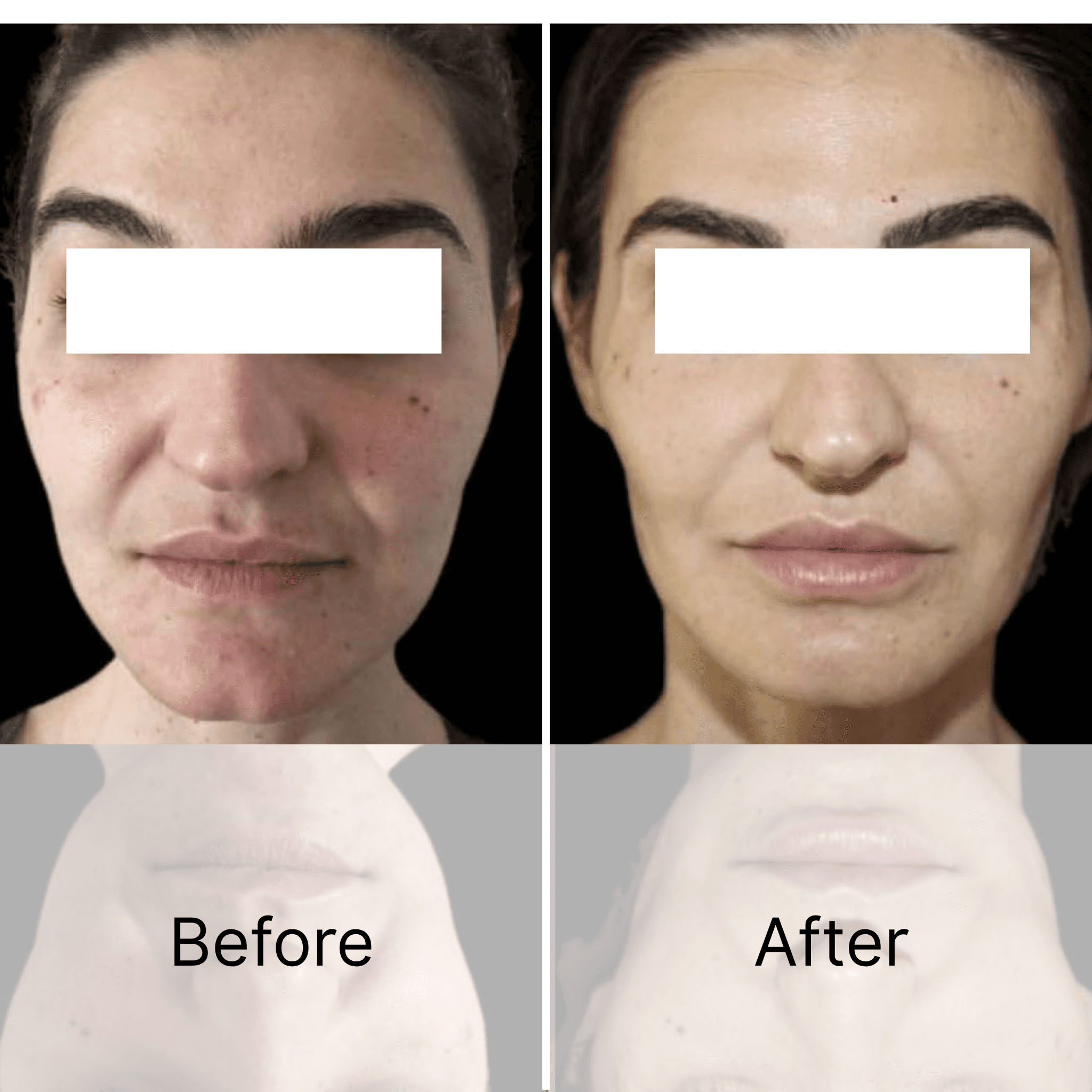 Hydroxyapatite Microsphere Facial Filler enhances facial firmness and skin elasticity, offering a natural lifting effect — OEM facial filler manufacturer in China.