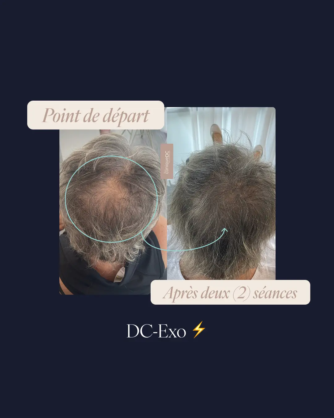 une photo du vortex du front d'un avant-après prp exosome perte de cheveux a laval dans une clinique medico-esthetique