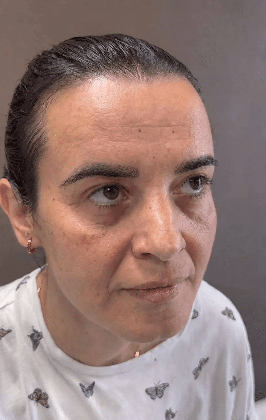 Caso 1 después del tratamiento
