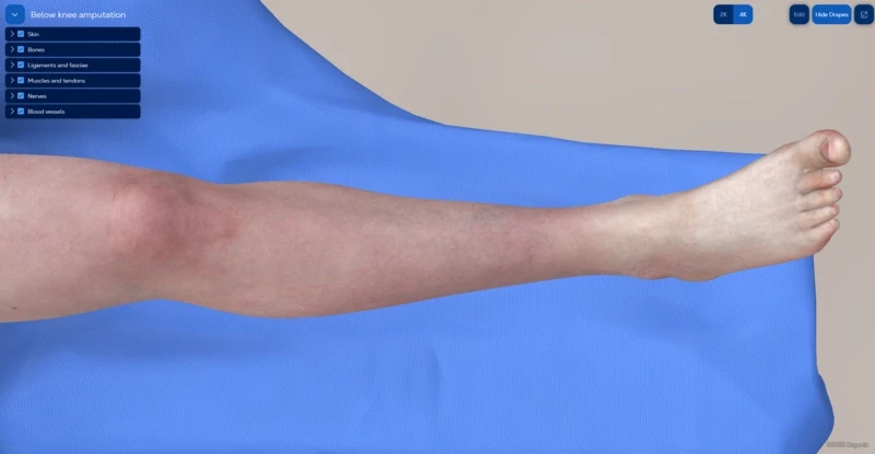 Below-knee amputation