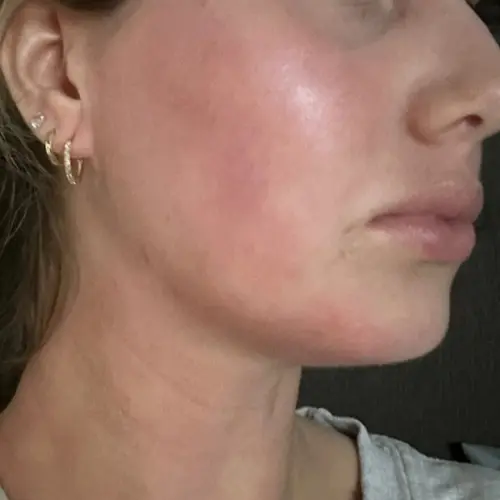 After lipids and ceramides treatment at The Vancouver Aesthetician — dermatitis resolved and skin visibly glowing, hydrated, and healthy