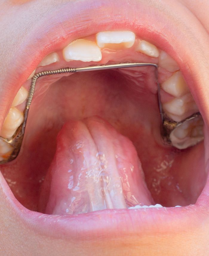 Fixed space maintainers in mouth