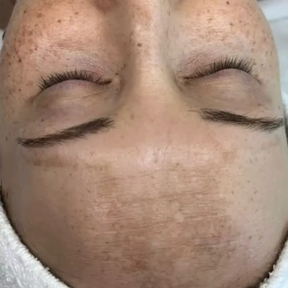 Before hydrating brightening facial at The Vancouver Aesthetician — visible melasma pigmentation and dull lacklustre skin tone