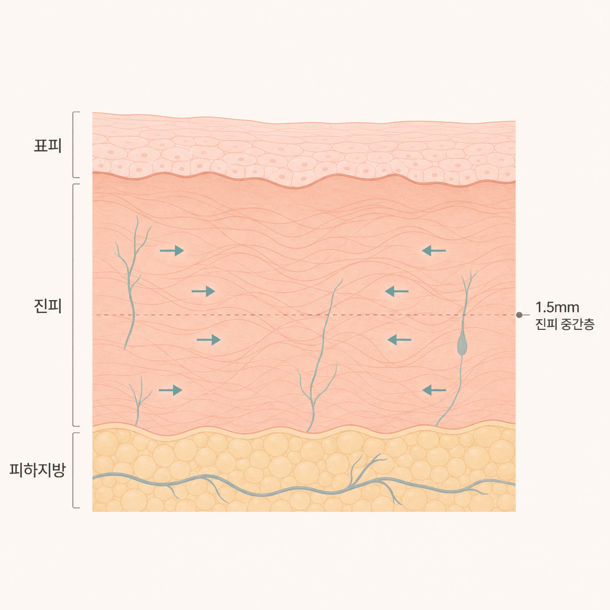 리프팅으로 수축한 진피층 콜라겐 섬유