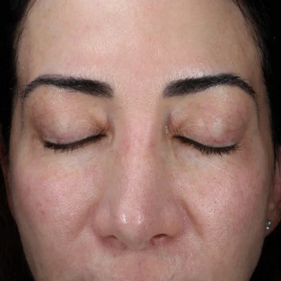 Before soothing anti-inflammatory treatment at The Vancouver Aesthetician — visible uneven skin tone and discolouration on skin