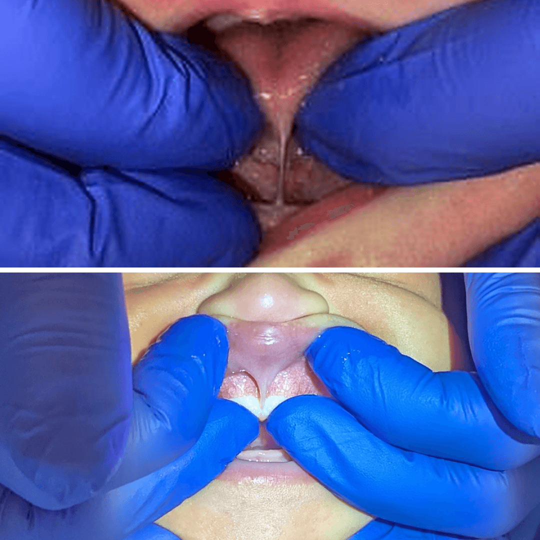 Close-up clinical image showing a baby’s tongue tie on the top and upper lip tie on the bottom before a frenectomy, with gloved hands gently lifting the tissue to show the restricted frenulum.