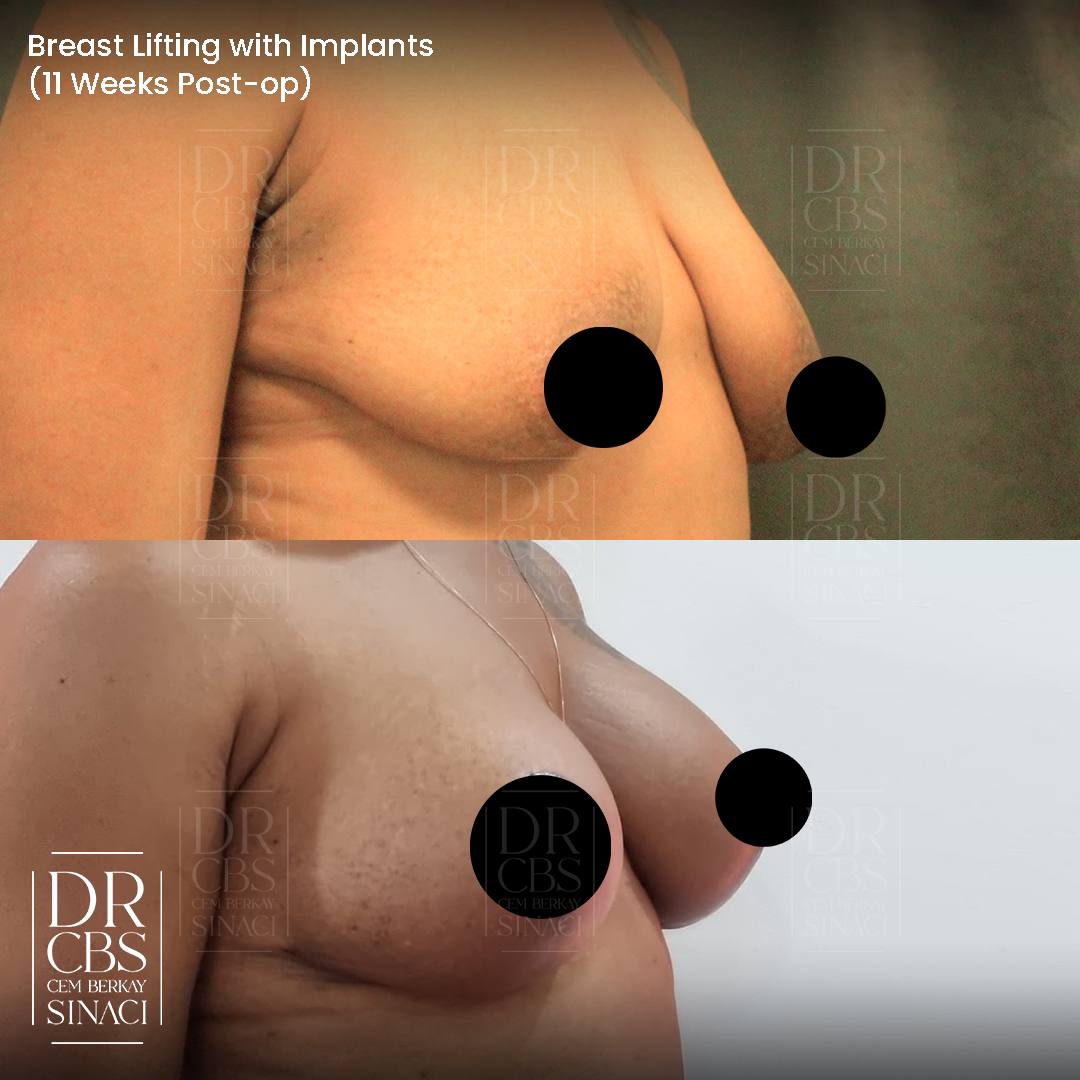 breast lift with implant mastopexy augmentation before after oblique view