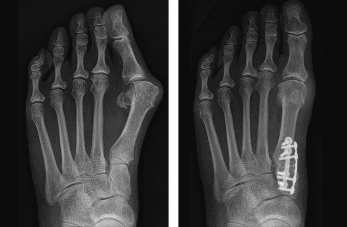 x-ray of Lapiplasty (Bunionectomy)