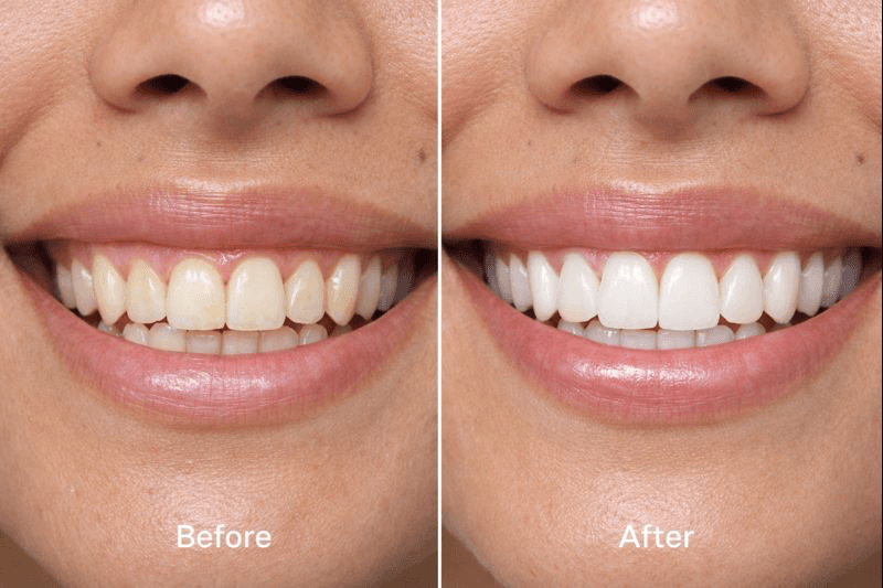 Before and after smile results