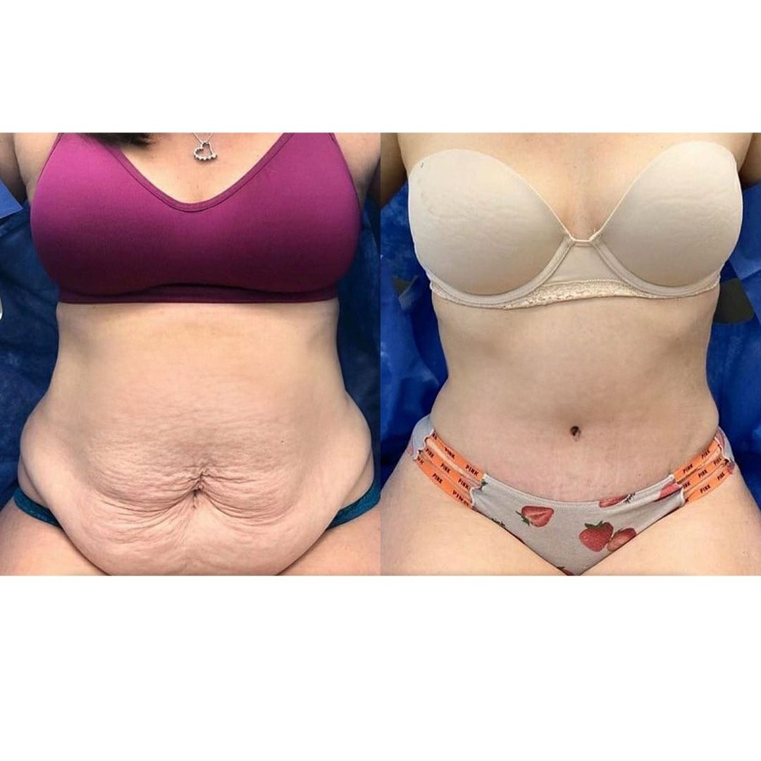 tummy tuck