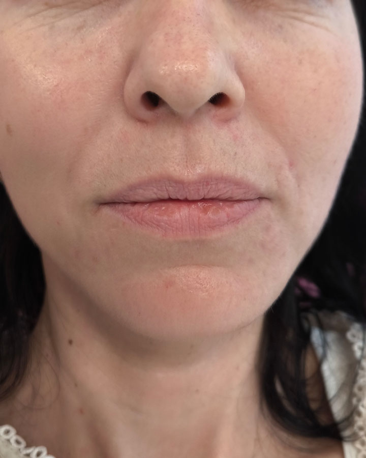 Detail pier pred ošetrením – strata plnosti a prirodzenej hydratácie v klinike Esthea