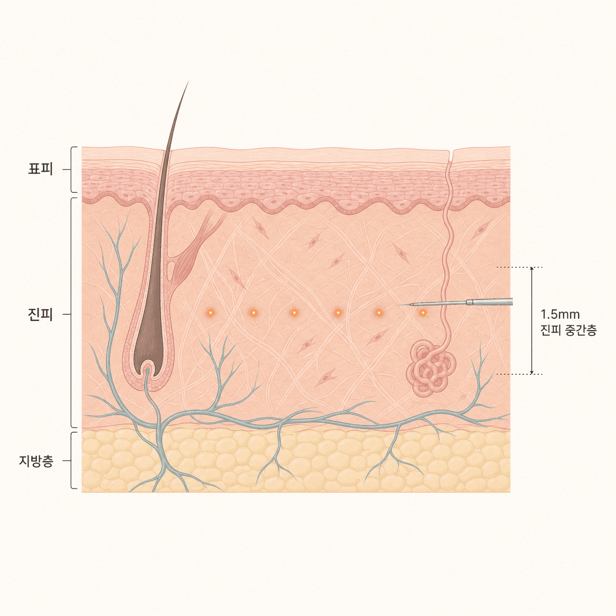 소프웨이브는 진피 중간층, 지방 관리 시술은 그 아래 지방층을 겨냥해요