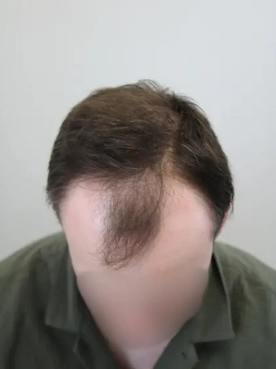 Before hair transplant – Stuart's FUE Hair Transplant Result