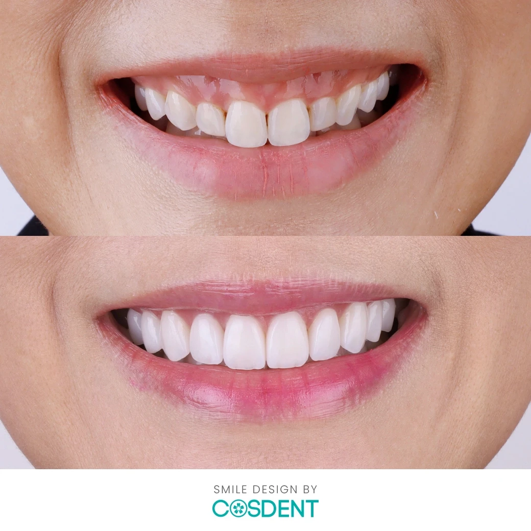 Ceramic Veneer Package