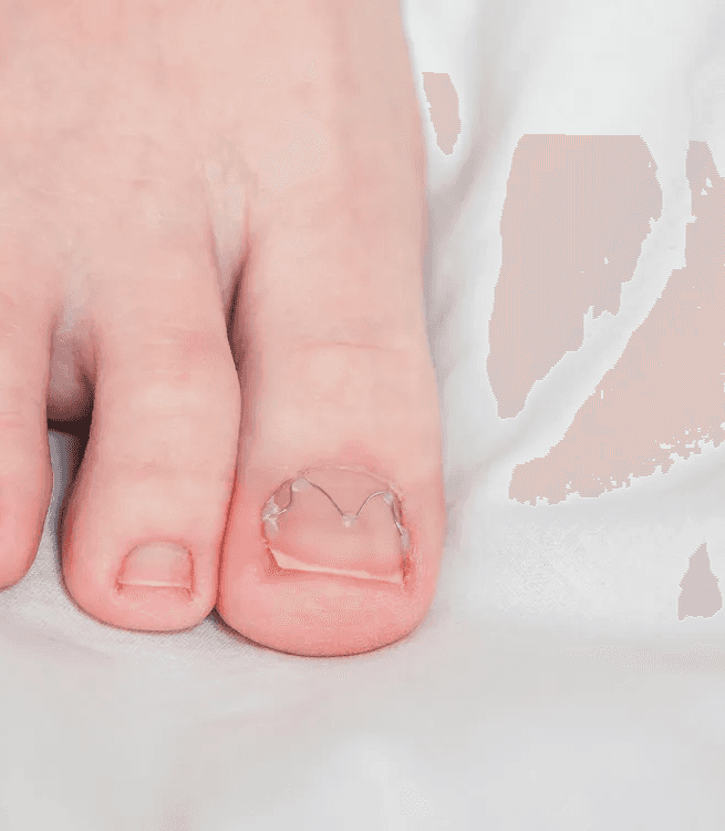 내성발톱 교정 와이어를 적용한 발톱 교정 치료 모습