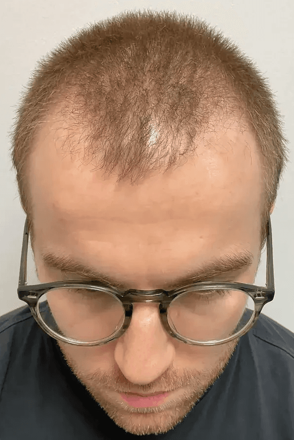 Before hair transplant – Luke's FUE Hair Transplant