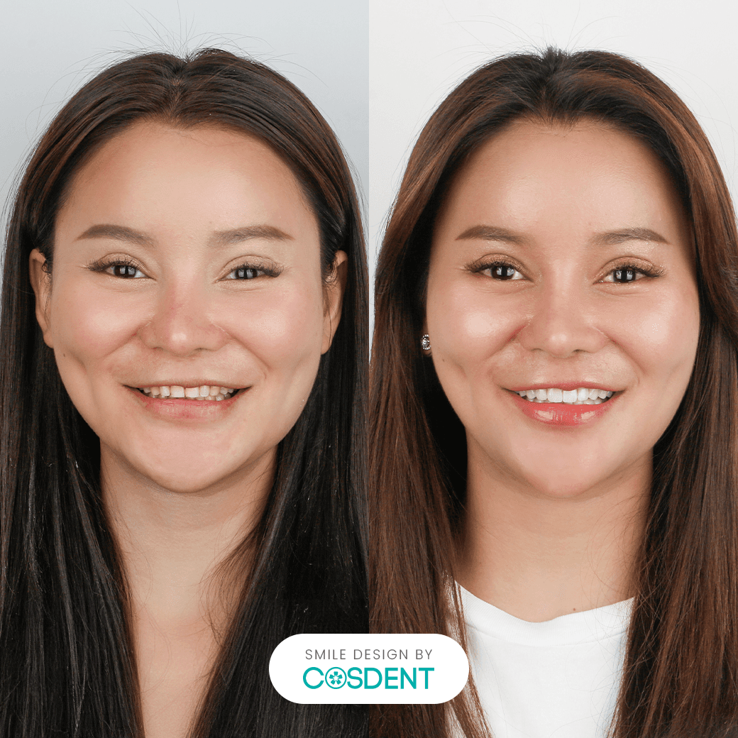 หน้ารูปหัวใจ ยิ้มกว้าง 20 ซี่