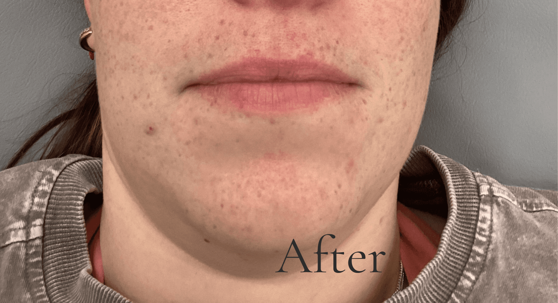 Close up of a person's chin and mouth area, word "After"