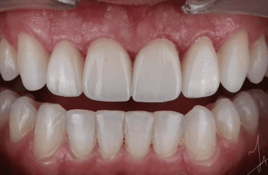 Close-up of a person's teeth showcasing a bright, white smile after a dental crown treatment.