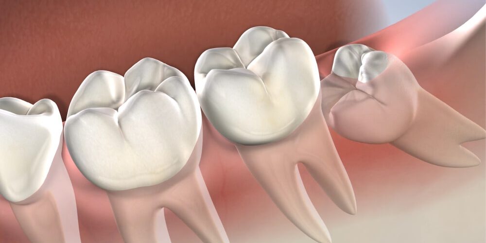 Sorriso com implante dentário ilustrado na gengiva, mostrando dentes brancos e saudáveis após reabilitação oral